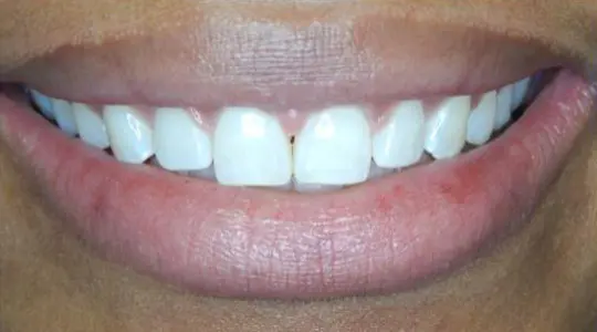Emiyah-Invisalign-after