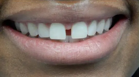 Emiyah-Invisalign-before