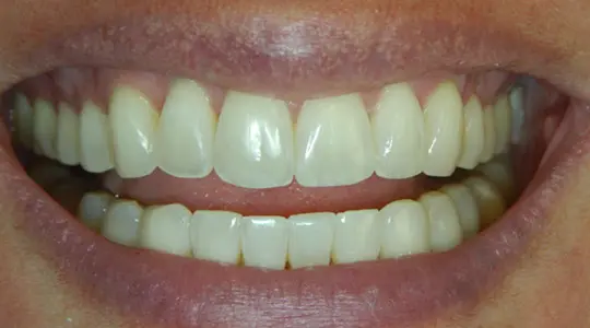 Lisa-Cosmetic-Bonding-after