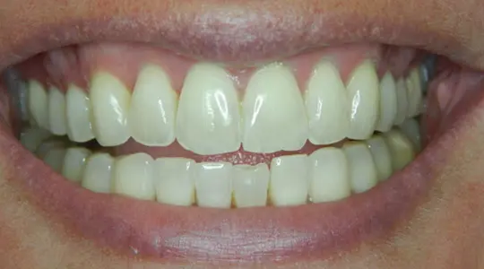 Lisa-Cosmetic-Bonding-before