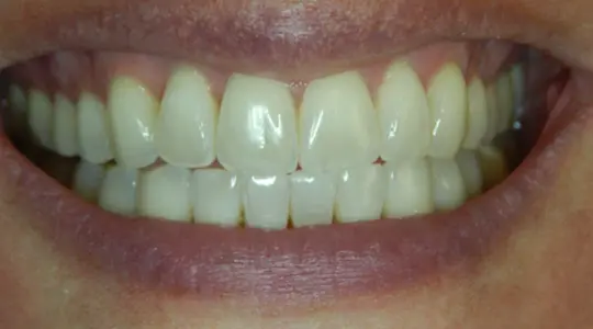 Lisa-Invisalign-after