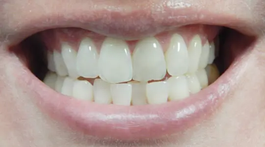 Lisa-Invisalign-before