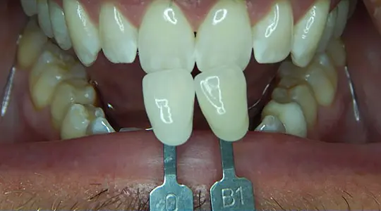 Zoom-Whitening-after