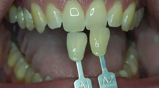 Zoom-Whitening-before