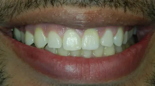 Invisalign After