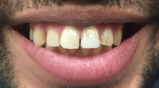 Invisalign Before