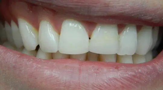 Veneers-Bonding-after-bonding