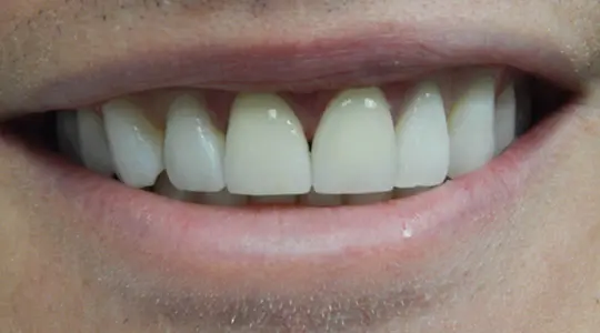 Veneers-Bonding-after-veneers