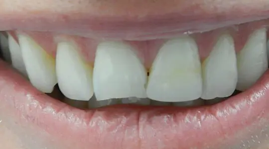 Veneers Bonding Before