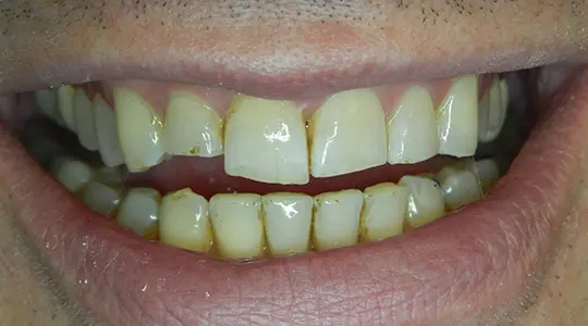 After Invisalign