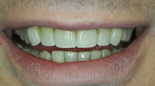 After Veneers