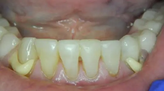 after cosmetic bonding