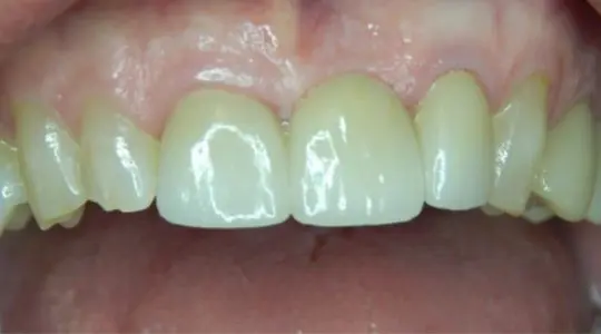 after cosmetic bonding2