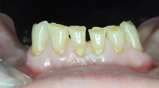 before cosmetic bonding