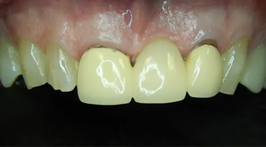 before cosmetic bonding2